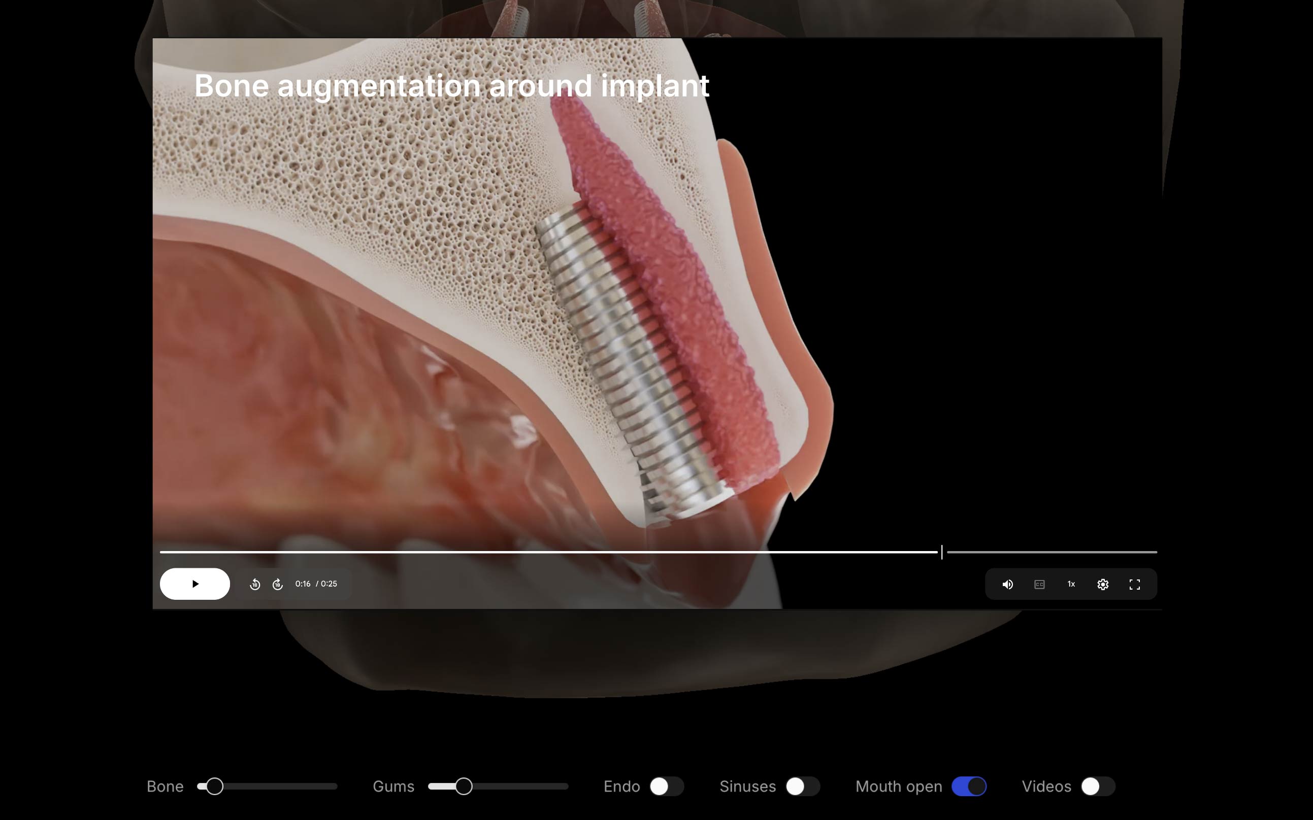 Bone augmentation video playing in Lift